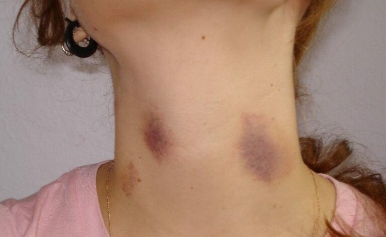 Est-ce que le litchi est dangereux ? Est-ce que le litchi est dangereux ?