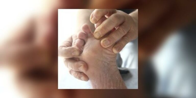 Comment Appelle-t-on la maladie entre les orteils ?