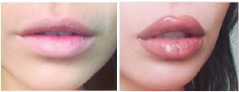 Comment avoir des lèvres plus petites ?