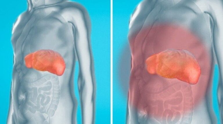 Comment éliminer la graisse du foie naturellement ?