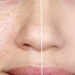 Comment enlever la peau noire de la lotte ?