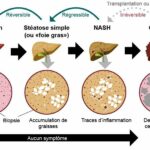 Comment évolue une stéatose ?