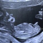 Comment savoir si fille ou garçon sans échographie ?