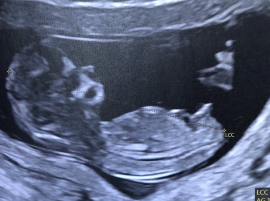 Comment savoir si fille ou garçon sans échographie ?