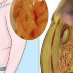 Comment se débarrasser de la graisse dans le foie ?