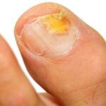 Comment se débarrasser des champignons sur la peau ?