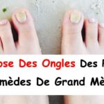 Comment soigner les mycoses des pieds remède de Grand-mère ?