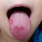 Comment soigner une mycose chez un bébé ?