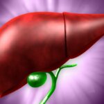 Comment soigner une stéatose du foie ?