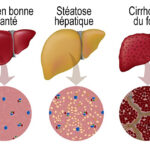 Comment soigner une stéatose hépatique non alcoolique ?