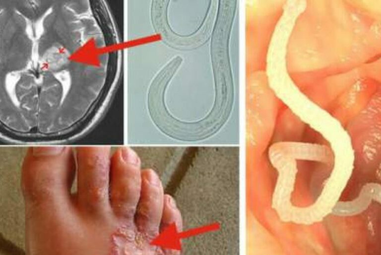 Comment tuer les vers dans le poisson ?