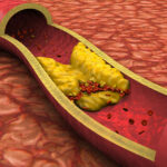 Est-ce que la banane est bon pour le cholestérol ?