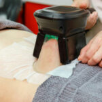 Est-ce que la cryolipolyse est vraiment efficace ?