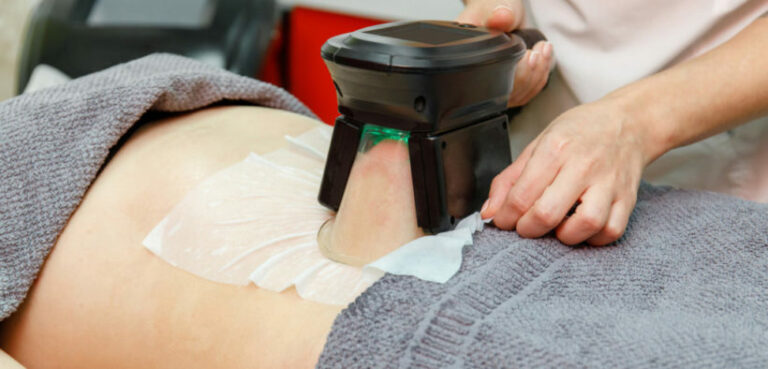 Est-ce que la cryolipolyse est vraiment efficace ?