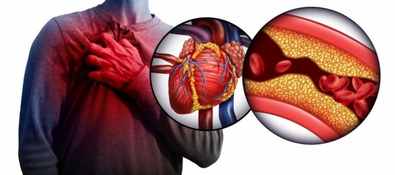 Est-ce que le cholestérol fatigue ?
