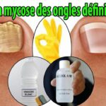 Quel médicament pour mycose des pieds ?