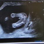 Quelle différence entre une grossesse fille et garçon ?