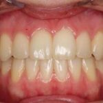 Quelle solution quand on a plus de dents ?