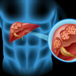 Quels sont les symptômes d'un foie fatigue ?