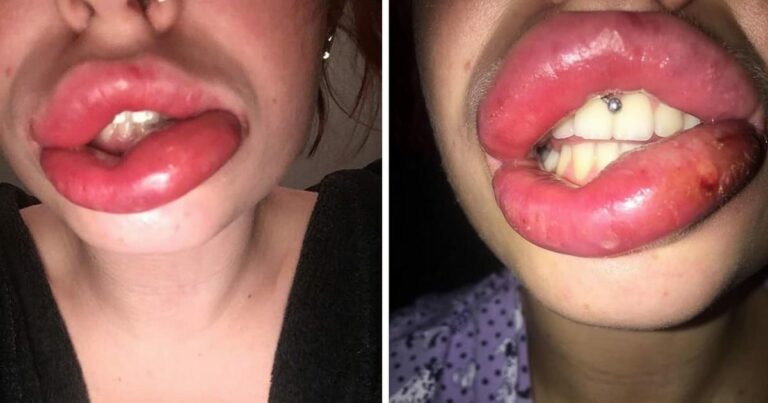 Qu’est-ce qui fait gonfler les lèvres ? Qu'est-ce qui fait gonfler les lèvres ?