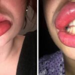 Qu'est-ce qui fait gonfler les lèvres ?