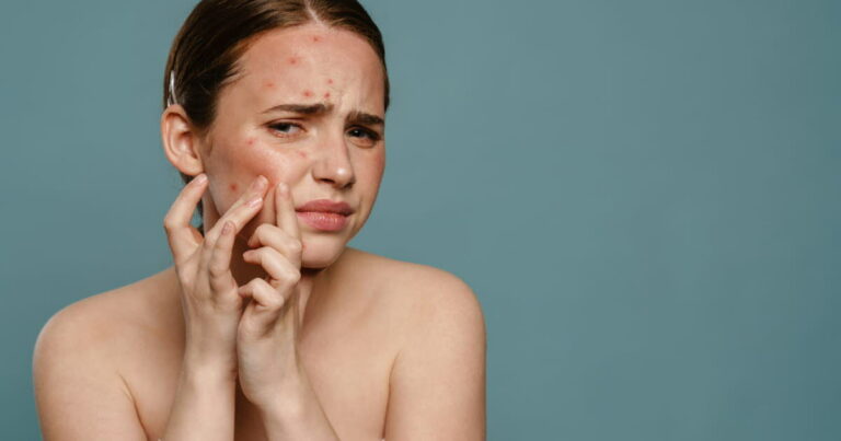 La nutrition. Les aliments gras et sucrés peuvent-ils causer de l’acné ?